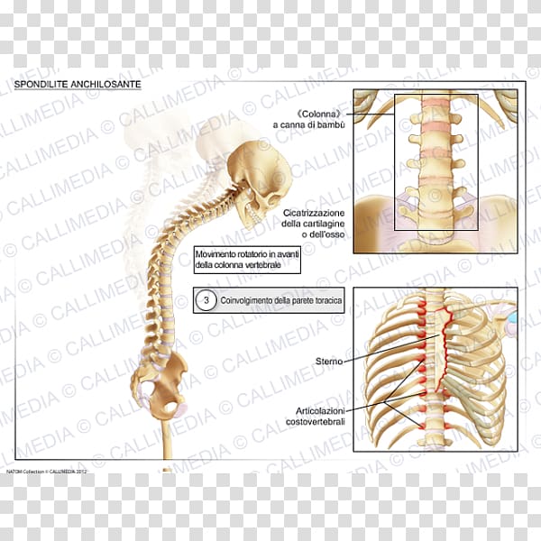 Ankylosing spondylitis National Institute of Arthritis and Musculoskeletal and Skin Diseases Rheumatology Ankylosis, japanese Bamboo transparent background PNG clipart