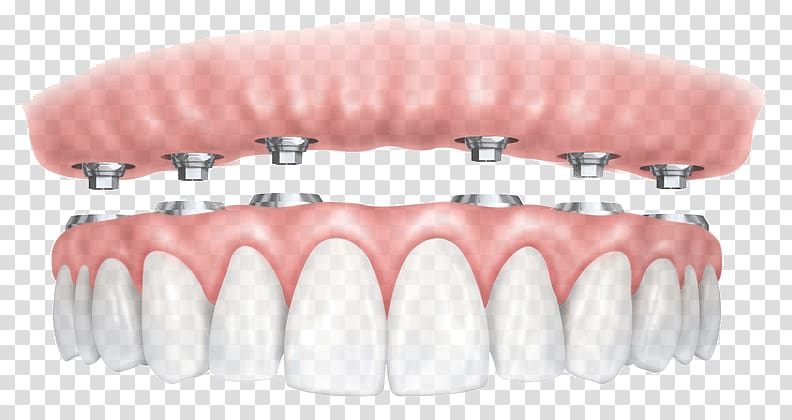 All-on-4 Dental implant Dentures Dentistry, others transparent background PNG clipart