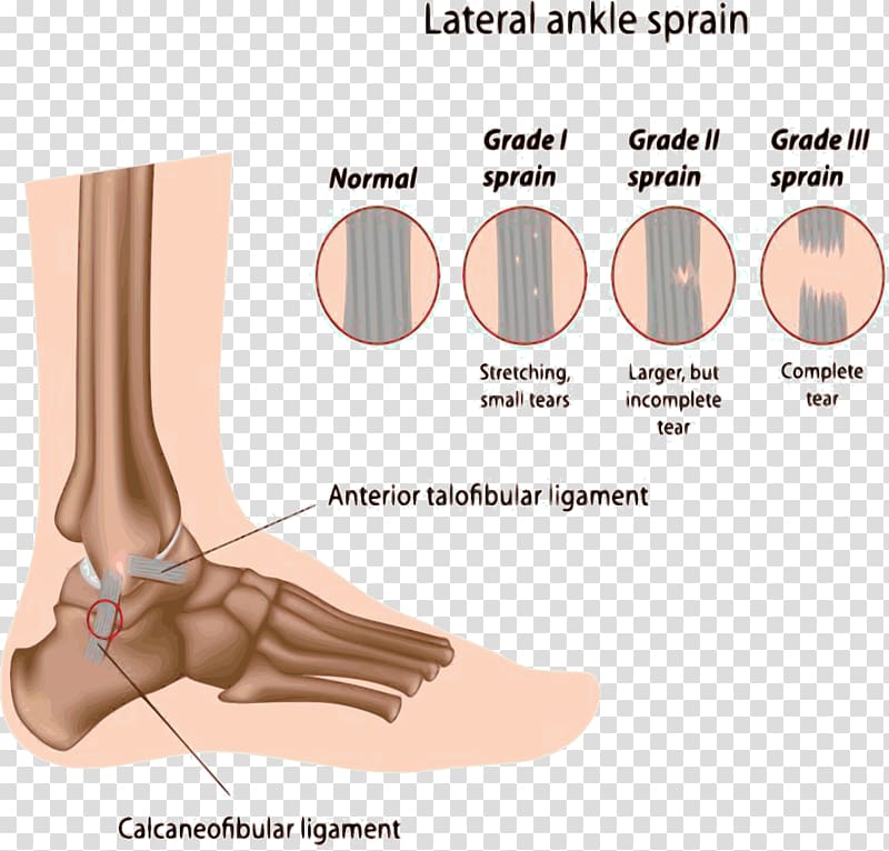 Sprained ankle High ankle sprain Injury, Chiropody Treatment transparent background PNG clipart