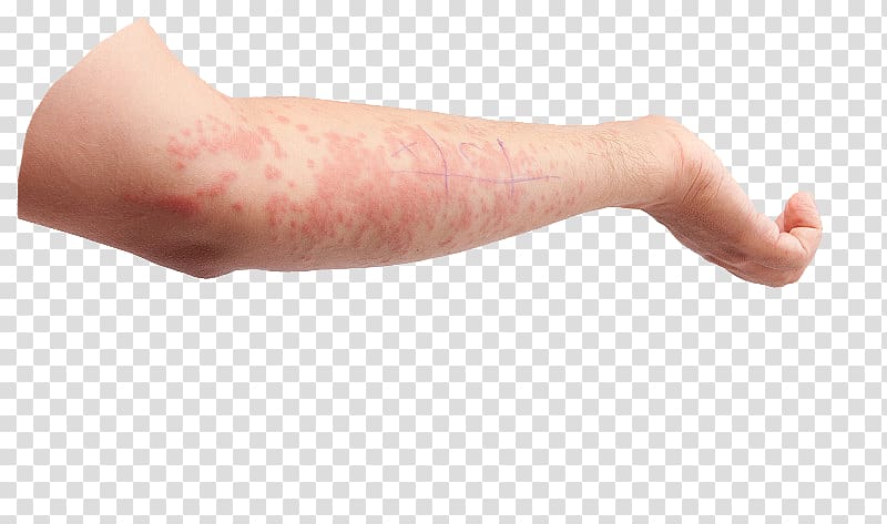 Skin Psoriasis Symptom Dermatology Thumb, Hand skin allergy transparent background PNG clipart