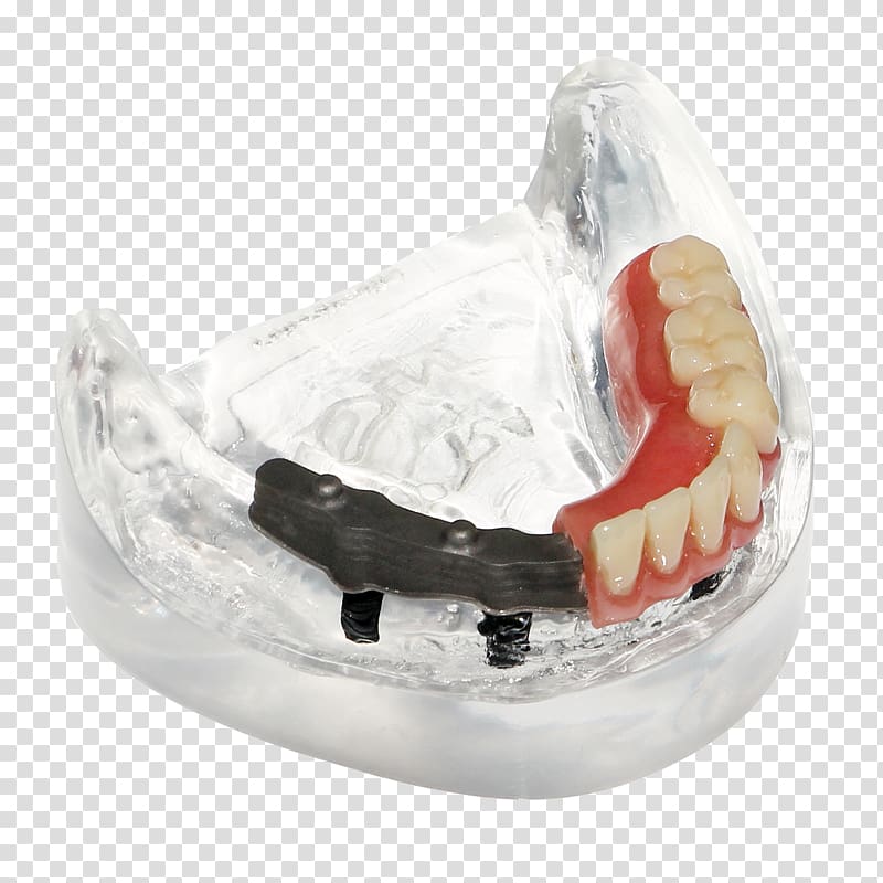 Dentures Tooth Made, Netherlands Digital data .be, braces with partial dentures transparent background PNG clipart