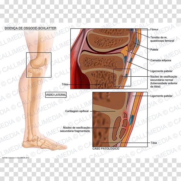 Osgood–Schlatter disease Tuberosity of the tibia Growing pains Therapy, Quadriceps Femoris Muscle transparent background PNG clipart
