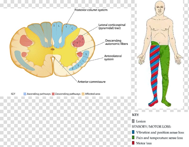Central cord syndrome Brain Spinal cord injury Upper motor neuron syndrome, Brain transparent background PNG clipart