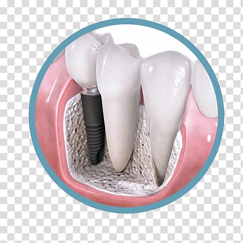 Dental implant Dentistry Dental surgery, crown transparent background PNG clipart
