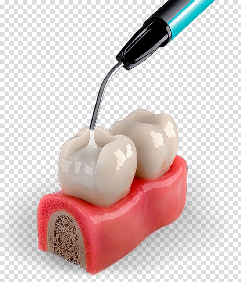 Tooth decay Dentistry Neck, dental material transparent background PNG clipart