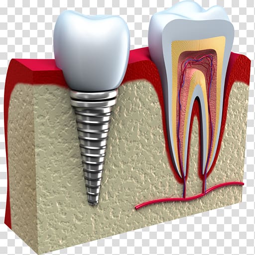 Dental implant Cosmetic dentistry, others transparent background PNG clipart