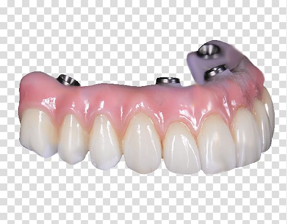 Tooth All-on-4 Dentures Bridge Dental implant, bridge transparent background PNG clipart