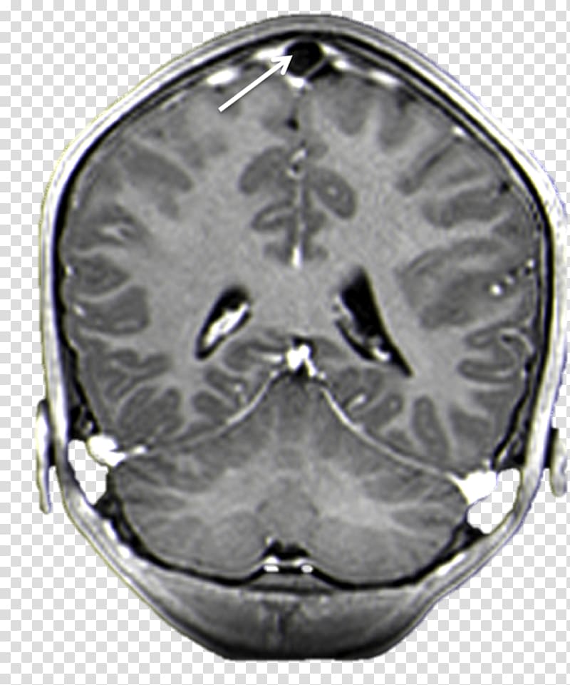 Brain Arachnoid granulation Superior sagittal sinus Magnetic resonance imaging Arachnoid mater, Brain transparent background PNG clipart