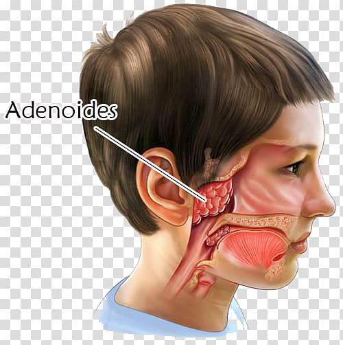 Adenoid Tonsillectomy Surgery Tonsillitis, nose transparent background PNG clipart