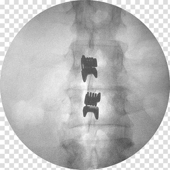 Interspinales muscles Vertebral column Spinal disc herniation Lumbar vertebrae, columna vertebral transparent background PNG clipart