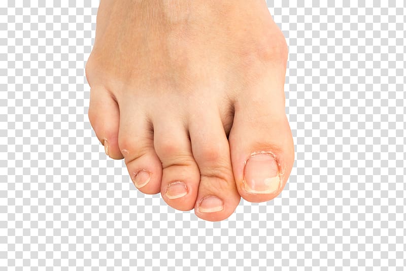 Hammer toe Bard Podiatry Associates: Mina Baskhron, DPM Nail Bunion, Nail transparent background PNG clipart