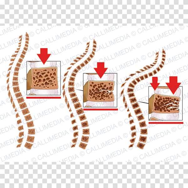Osteoporosis Bone fracture Vertebral column Vertebral compression fracture, giraffe transparent background PNG clipart