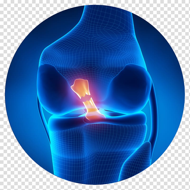 Anterior cruciate ligament injury Medial collateral ligament Anterior cruciate ligament reconstruction, ligament transparent background PNG clipart