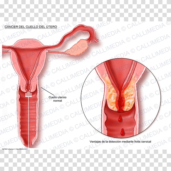 Cervical cancer Uterine cancer Cervix Uterus, utero transparent background PNG clipart