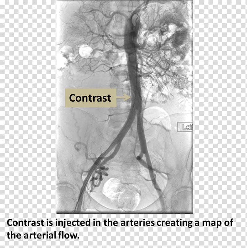 Computed tomography angiography Femoral artery Coronary catheterization Medical procedure, Femoral Artery transparent background PNG clipart