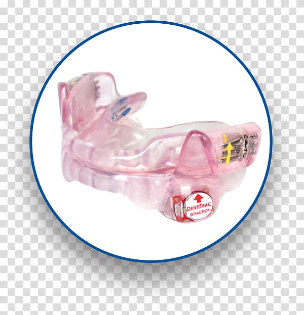 Mandibular advancement splint Patient Sleep apnea Bowie Positive airway pressure, mandibular advancement splints transparent background PNG clipart