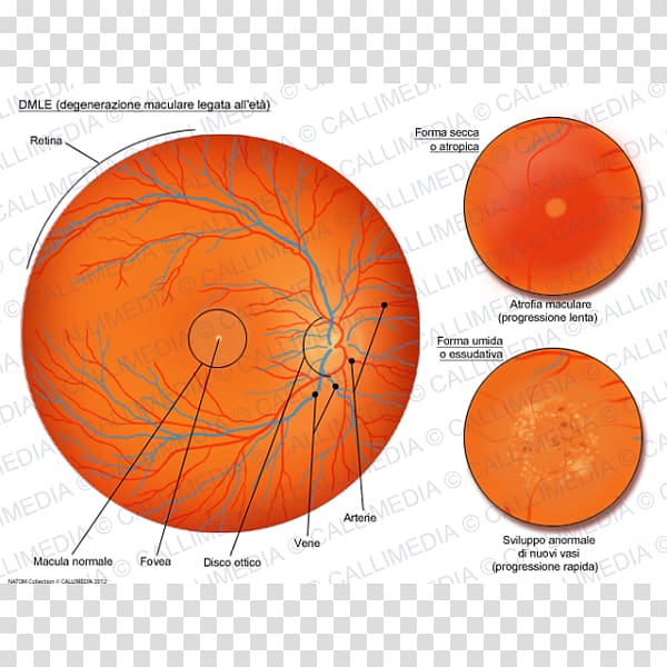 Macular degeneration Macula of retina Old age Atrophy, Eye transparent background PNG clipart