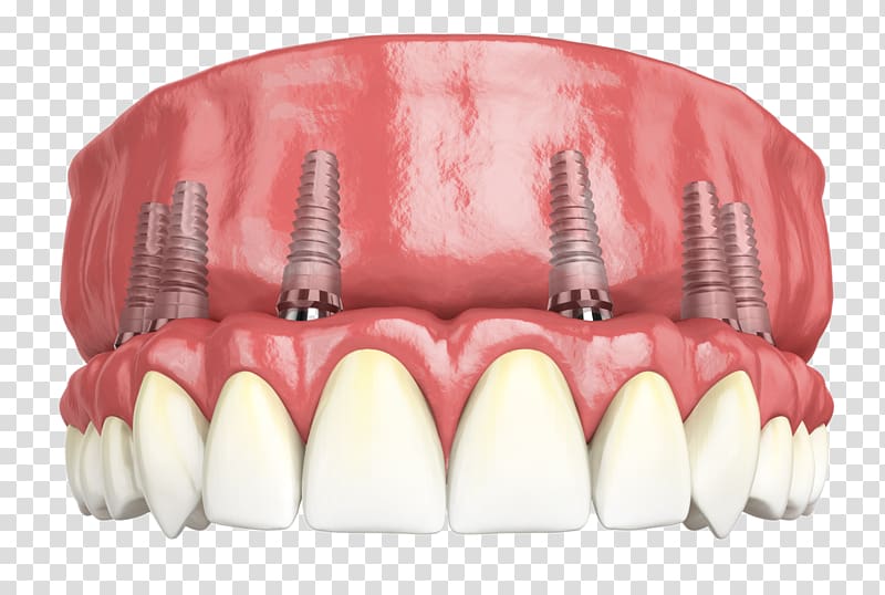 Hybridge Dental Implants Giesy Family and Implant Dentistry, dental restoration transparent background PNG clipart