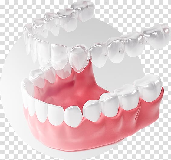 Tooth Элайнер Dental braces Clear aligners Zwarcie, smile transparent background PNG clipart