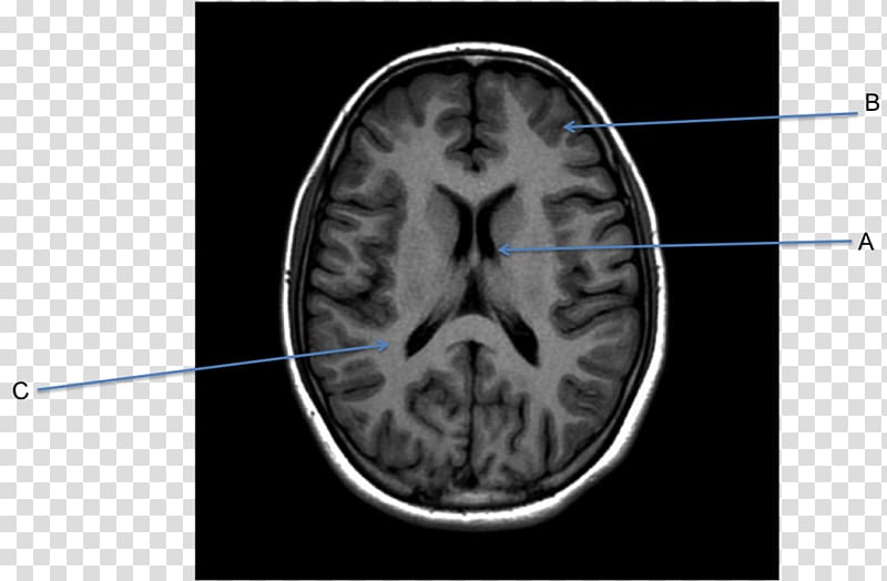 Magnetic resonance imaging of the brain Computed tomography Magnetic resonance imaging of the brain Neuroimaging, African American Business transparent background PNG clipart