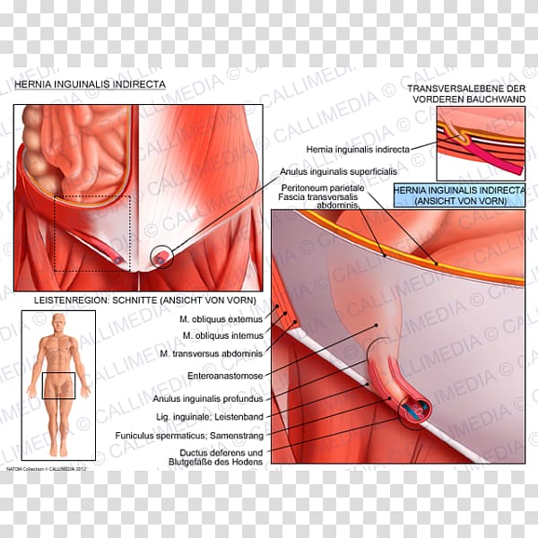 Inguinal hernia Abdominal external oblique muscle Inguinal canal Abdominal internal oblique muscle, others transparent background PNG clipart