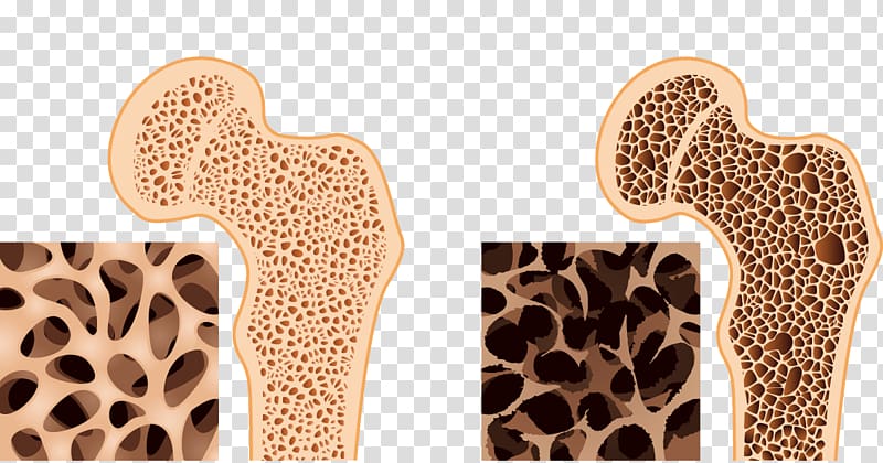 Bone density Osteoporosis Bone health Osteopenia, health transparent background PNG clipart