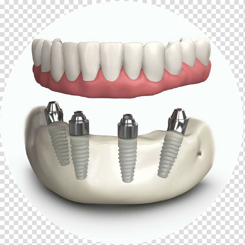 Tooth Dentures Dental implant Dentistry, others transparent background PNG clipart