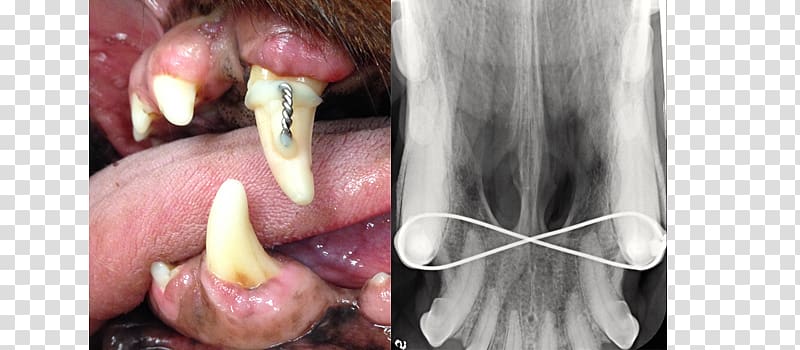 Canine tooth Mouth Maxillary canine Human tooth, others transparent background PNG clipart