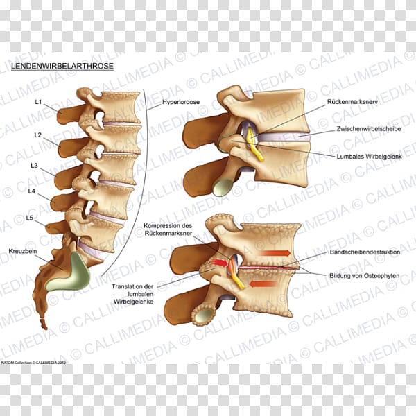 Joint Osteoarthritis Lumbar vertebrae Process Human back, artrosis de rodilla transparent background PNG clipart
