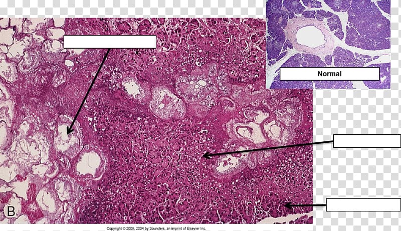 Acute pancreatitis Histopathology Histology Necrosis Acute disease, microscope transparent background PNG clipart