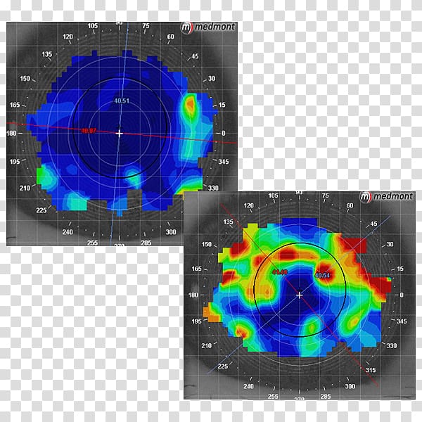 Dry eye syndrome Corneal topography Eye examination Optometry, Eye transparent background PNG clipart