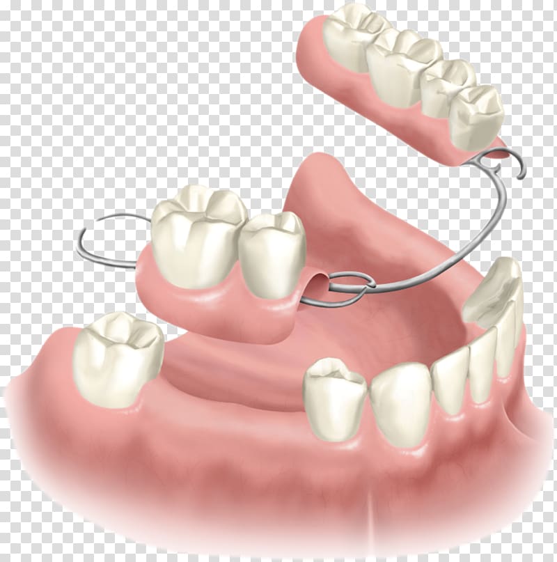 Removable partial denture Dentures Dental implant Dentistry, implant tooth transparent background PNG clipart