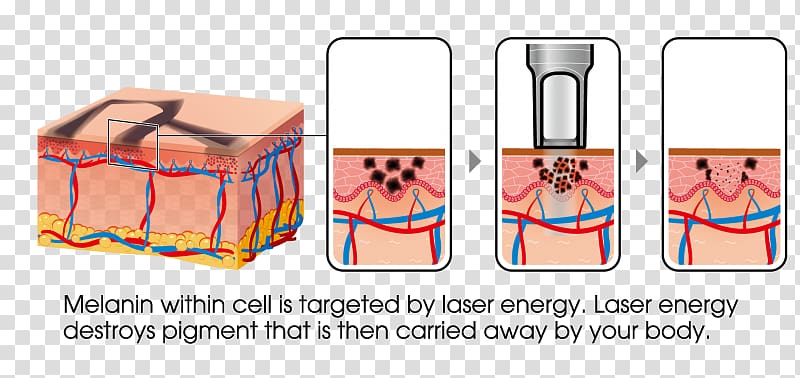 Tattoo removal Nd:YAG laser Détatouage laser, gradual discoloration transparent background PNG clipart