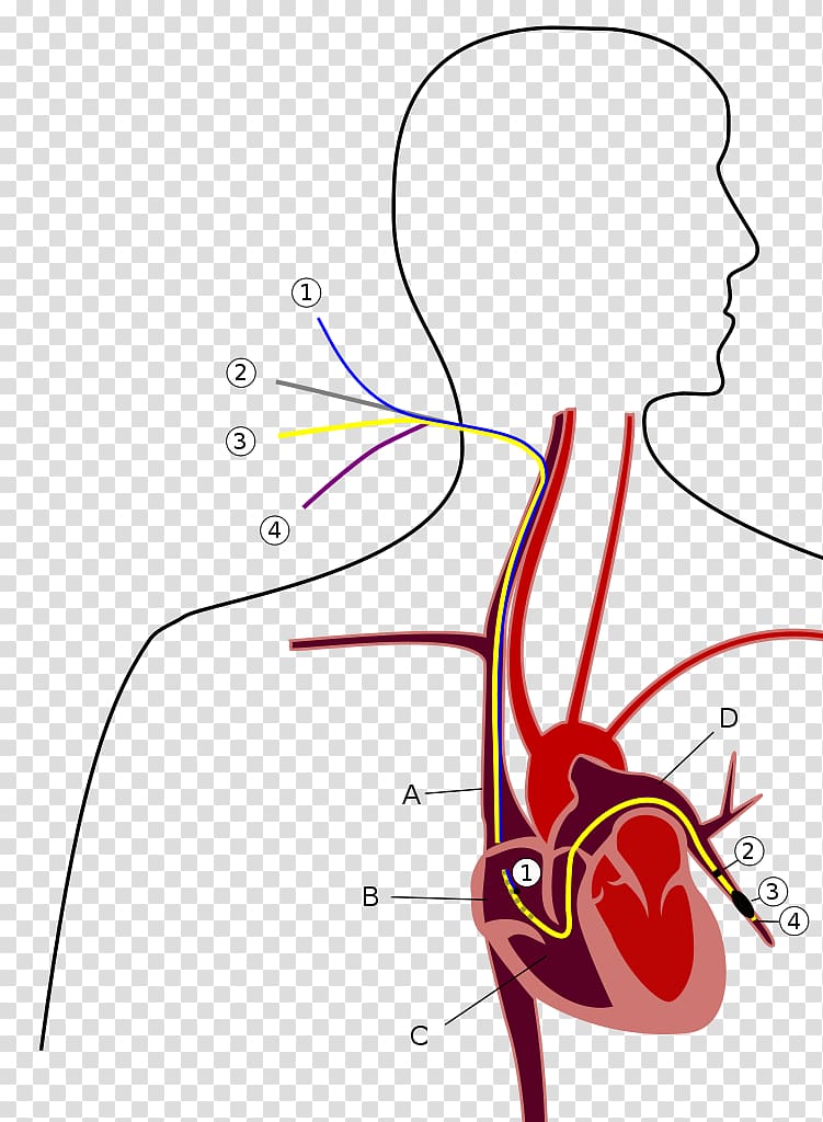 Pulmonary artery catheter Pulmonary hypertension Pulmonary wedge pressure, heart transparent background PNG clipart