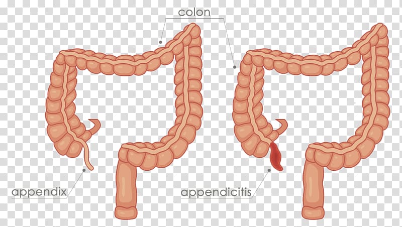 Appendix Appendicitis Appendectomy Organ Ascending colon, appendix transparent background PNG clipart