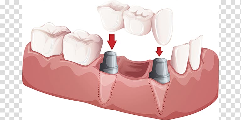 Bridge Dentistry Crown Dental implant, bridge transparent background PNG clipart
