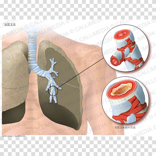 Acute bronchitis Asthma Lung Bronchiolitis Bronchus, Bronchial transparent background PNG clipart