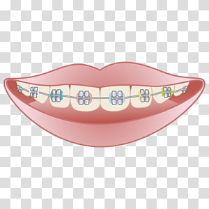 dental braces clipart free