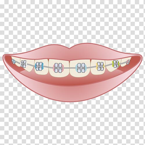 矯正歯科 Dentistry Dental braces Mouthguard, Dental Braces transparent background PNG clipart