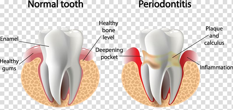 Periodontal disease Gums Gingivitis Periodontology Dentistry, health transparent background PNG clipart