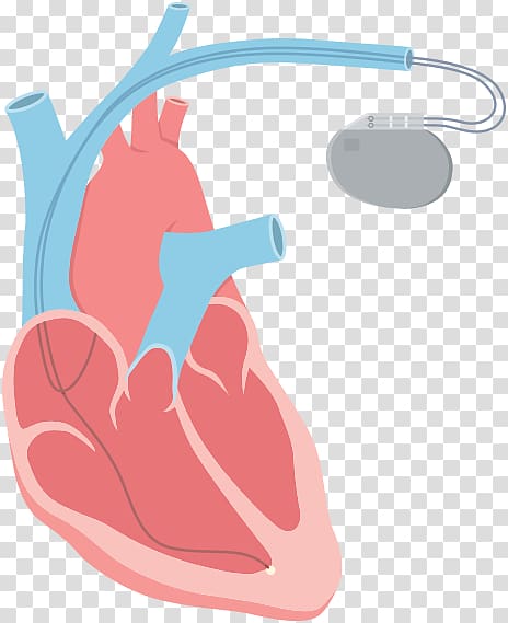 Heart arrhythmia Tachycardia Catheter ablation, heart beat faster transparent background PNG clipart
