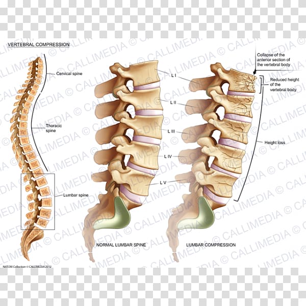 Vertebral compression fracture Vertebral column Lumbar vertebrae Bone fracture, vertebral transparent background PNG clipart