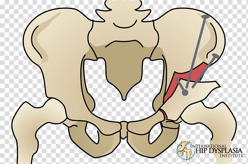 Finger Osteotomy Hip dysplasia Surgery, others transparent background PNG clipart