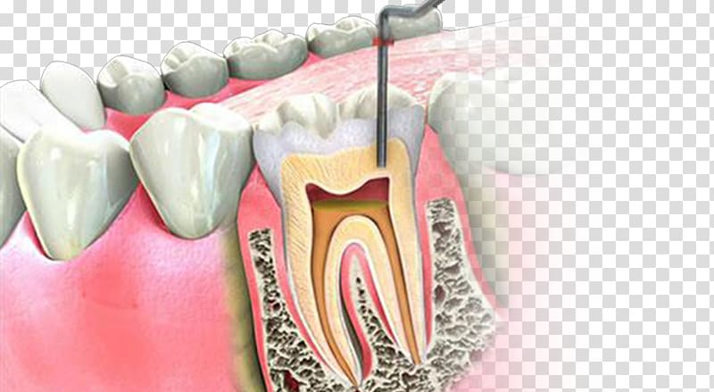 Endodontic therapy Root canal Endodontics Dentistry, root canal transparent background PNG clipart