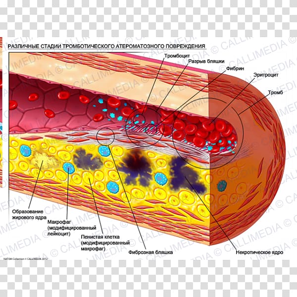 Atheroma Atherosclerosis Artery Stenosis Disease, eritrocito transparent background PNG clipart
