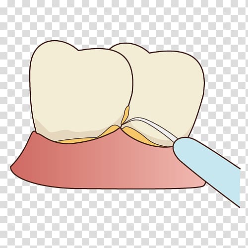 Tooth decay 歯科 Dentist Periodontal disease, view transparent background PNG clipart