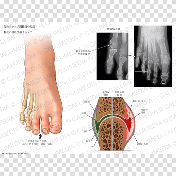 Nail Arthritic pain Rheumatoid arthritis Foot Joint, Nail transparent background PNG clipart