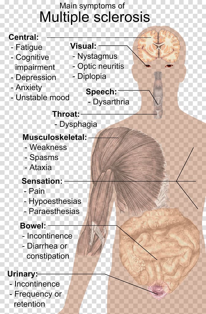 Multiple sclerosis signs and symptoms Multiple sclerosis signs and symptoms Medical sign Neck pain, Multiple Sclerosis transparent background PNG clipart