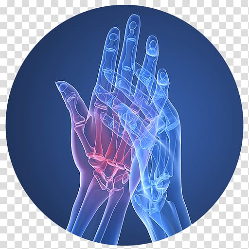 Rheumatoid arthritis Therapy Disease Pharmaceutical drug, arthritis transparent background PNG clipart