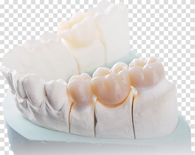 Dentistry Jaw Dental restoration Zirconium dioxide Wholesale, colorful shading transparent background PNG clipart